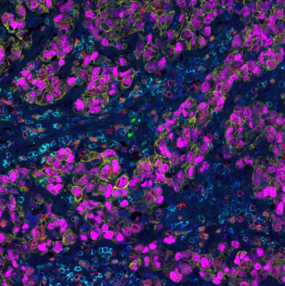 Cell Proliferation and Metastasis PathPlex Panel