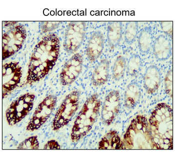 Colorectal cancer biomarkers Antibody Panel