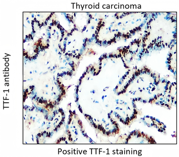 Lung cancer biomarkers Antibody Panel