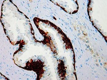 Basal Cell Marker Cocktail 1, p63 Protein + HMW Cytokeratin Antibody